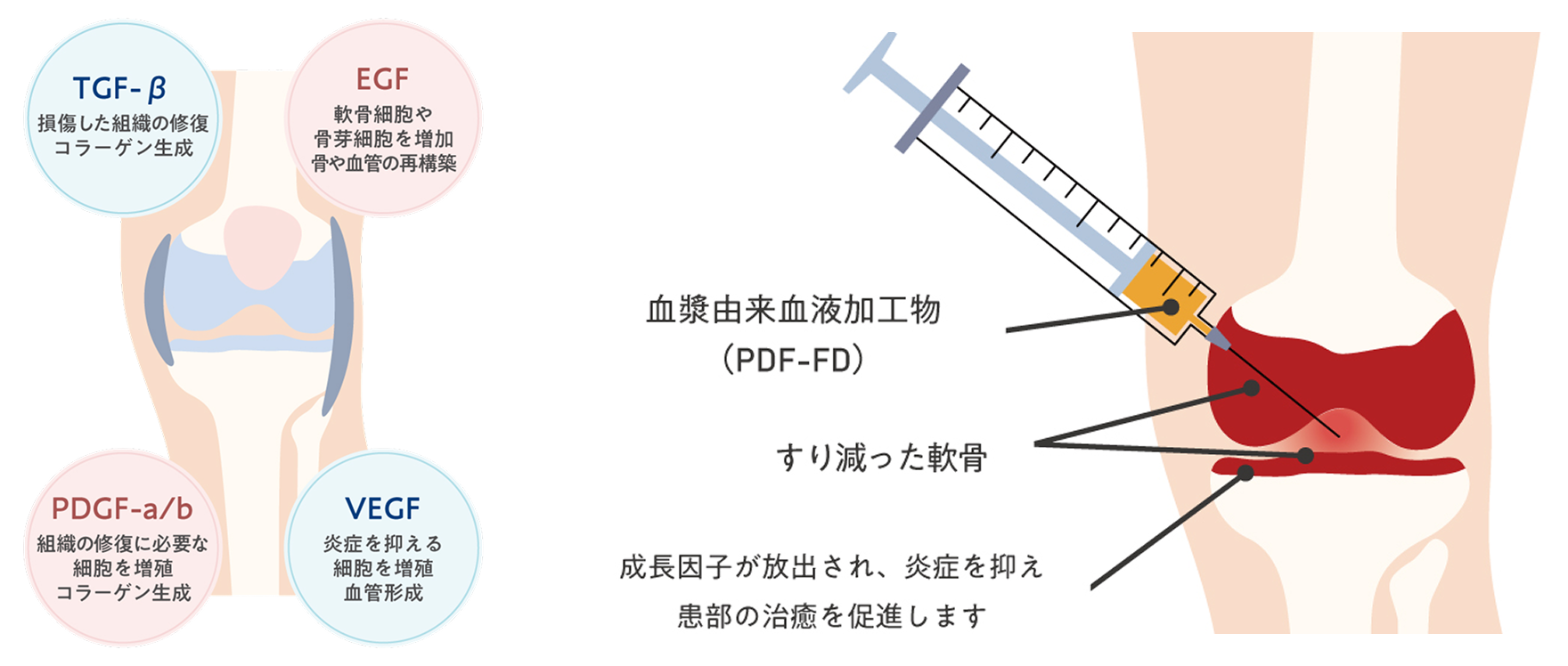 成長因子の説明。TGF-β：損傷した組織の修復、コラーゲン生成。EGF：軟骨細胞や骨芽細胞を増加、骨や血管の再構築。PDGF-a/b：組織の修復に必要な細胞を増殖、コラーゲン生成。VEGF：炎症を抑える、細胞を増殖、血管形成。 治療のメカニズム：すり減った軟骨の間に血漿由来血液加工物を注射することで、成長因子が放出され、炎症を抑え、幹部の治癒を促進します。