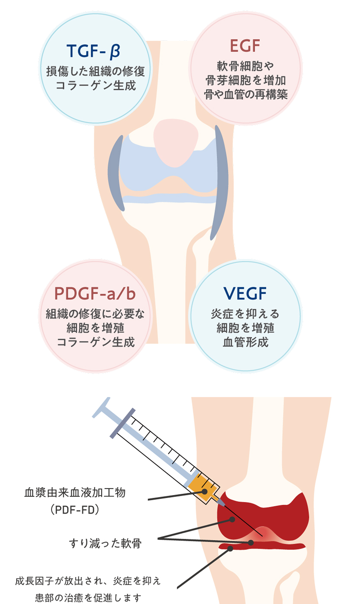 成長因子の説明。TGF-β：損傷した組織の修復、コラーゲン生成。EGF：軟骨細胞や骨芽細胞を増加、骨や血管の再構築。PDGF-a/b：組織の修復に必要な細胞を増殖、コラーゲン生成。VEGF：炎症を抑える、細胞を増殖、血管形成。 治療のメカニズム：すり減った軟骨の間に血漿由来血液加工物を注射することで、成長因子が放出され、炎症を抑え、幹部の治癒を促進します。