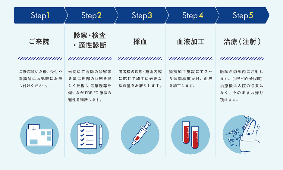 Step1ご来院：ご来院いただいた後、受付や看護師にお気軽にお申し付けください。Step2診察・検査・適性診断：当院にて医師の診察等を基に患部の状態を詳しく把握し、治療歴等を伺いながらPDF-FD療法の適性を判断します。Step3採血：患者様の疾患・施術内容に応じて加工に必要な採血量をお取りします。Step4血液加工：提携加工施設にて2〜3週間程度かけ、血液を加工します。Step5治療 (注射)：医師が患部内に注射します。(※5〜10分程度) 治療後は入院の必要はなく、そのままお帰り頂けます。